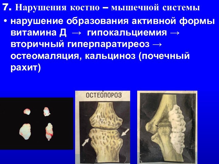 7. Нарушения костно – мышечной системынарушение образования активной формы витамина Д →