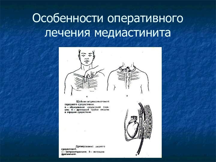 Особенности оперативного лечения медиастинита