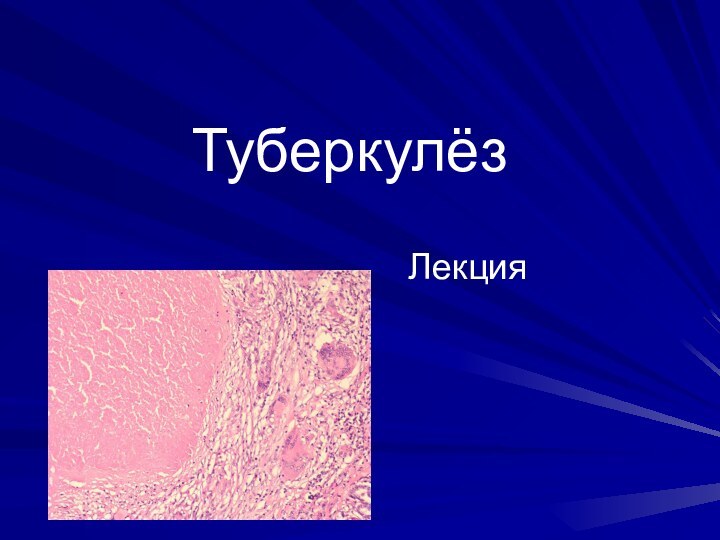 ТуберкулёзЛекция