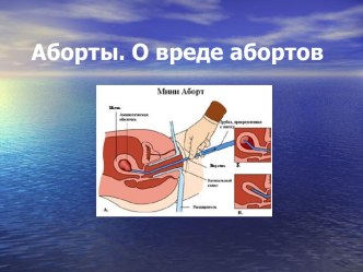 Аборты. О вреде абортов