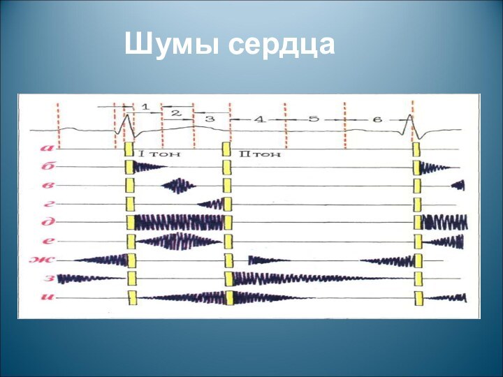 Шумы сердца.