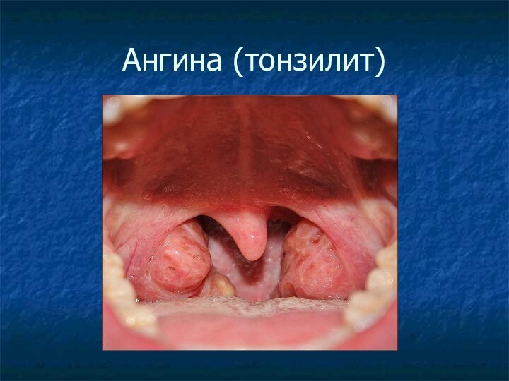 Ангина (тонзилит)