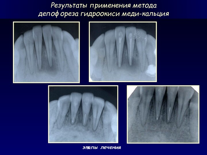 этапы леченияРезультаты применения методадепофореза гидроокиси меди-кальция