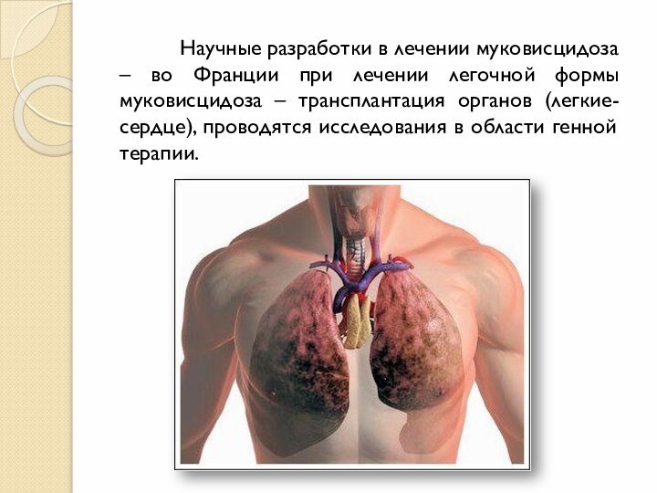 Научные разработки в лечении муковисцидоза