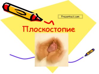 Плоскостопие