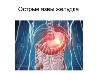 ЯЗВЫ ЖЕЛУДКА