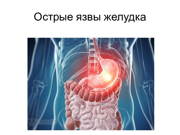 Острые язвы желудка