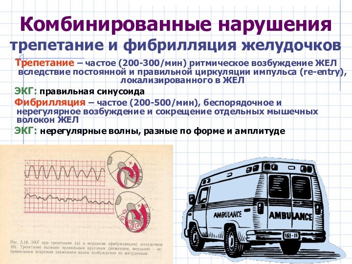 Комбинированные нарушения трепетание и фибрилляция желудочковТрепетание – частое (200-300/мин) ритмическое возбуждение ЖЕЛ