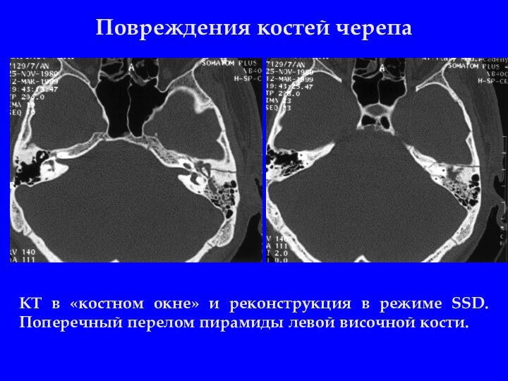 Повреждения костей черепаКТ в «костном окне» и реконструкция в режиме SSD. Поперечный