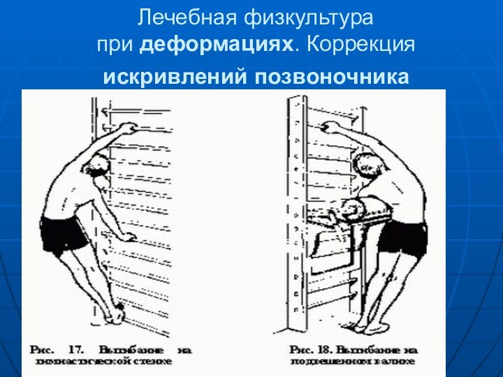 Лечебная физкультура при деформациях. Коррекция искривлений позвоночника