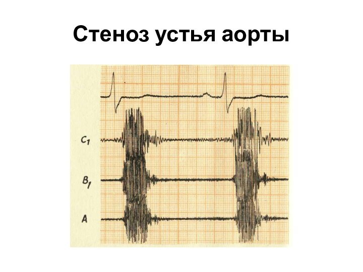 Стеноз устья аорты