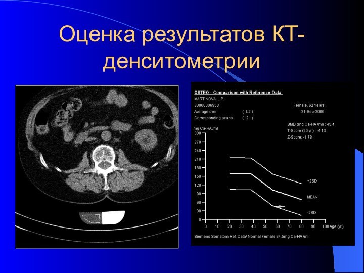 Оценка результатов КТ-денситометрии