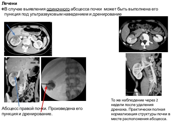 В случае выявления одиночного абсцесса почки может быть выполнена его пункция под