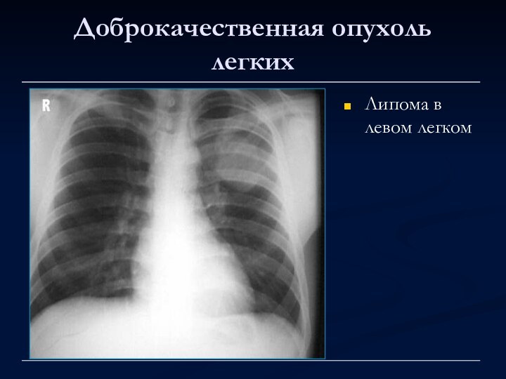 Доброкачественная опухоль легкихЛипома в левом легком