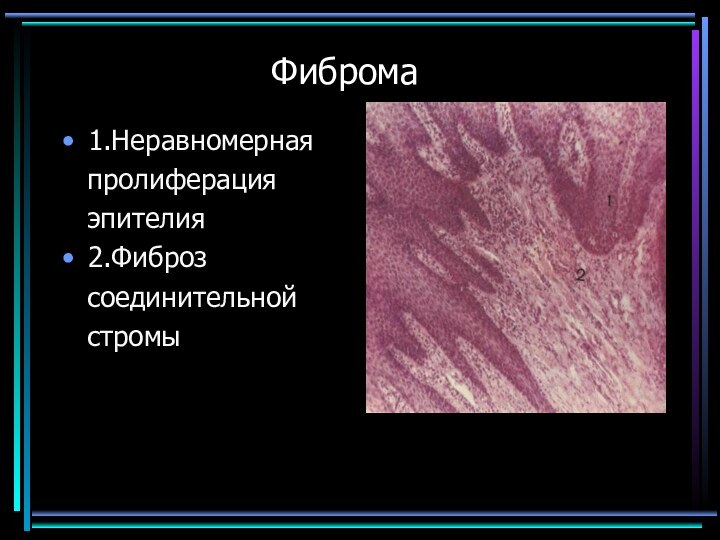 Фиброма1.Неравномерная  пролиферация  эпителия2.Фиброз  соединительной  стромы