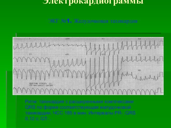 Электрокардиограммы  ЭКГ №1. Желудочковая тахикардия Ритм: тахикардия с расширенными комплексами QRS