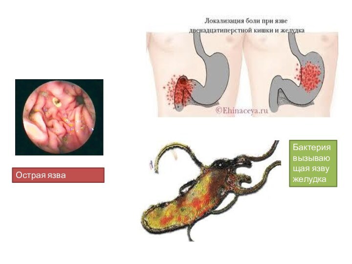 Острая язва Бактерия вызывающая язву желудка