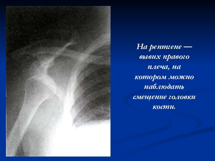 На рентгене — вывих правого плеча, накотором можно наблюдать смещение головкикости.