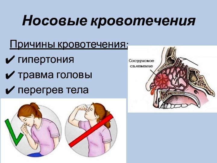 Носовые кровотеченияПричины кровотечения:гипертониятравма головыперегрев тела