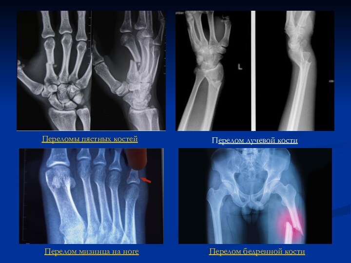 Переломы пястных костей Перелом лучевой костиПерелом мизинца на ногеПерелом бедренной кости