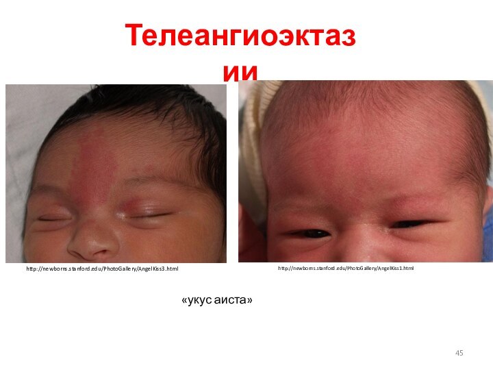 Телеангиоэктазии http://newborns.stanford.edu/PhotoGallery/AngelKiss3.htmlhttp://newborns.stanford.edu/PhotoGallery/AngelKiss1.html«укус аиста»