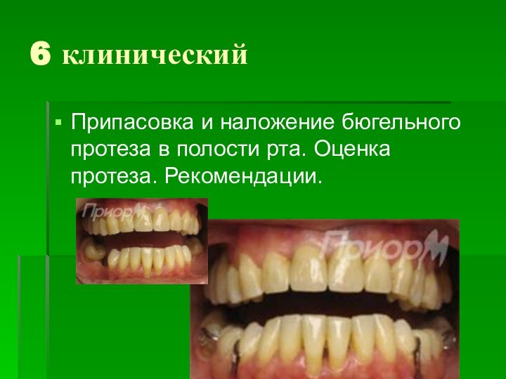 6 клиническийПрипасовка и наложение бюгельного протеза в полости рта. Оценка протеза. Рекомендации.