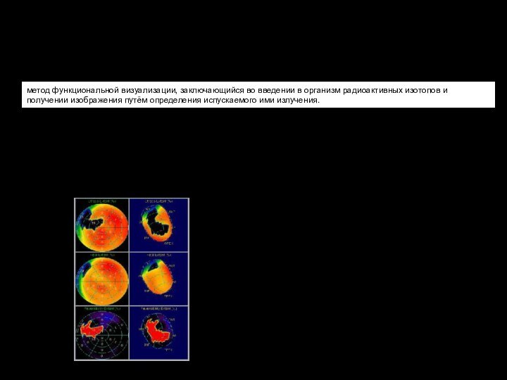 метод функциональной визуализации, заключающийся во введении в организм радиоактивных изотопов и получении изображения путём