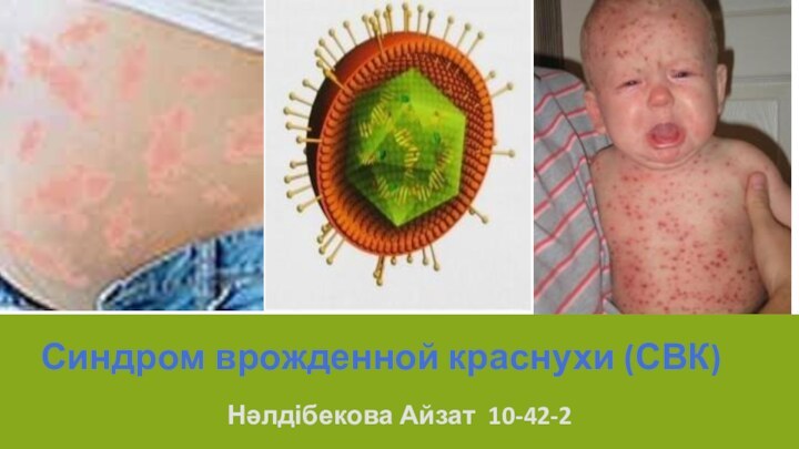 Синдром врожденной краснухи (СВК)Нәлдібекова Айзат 10-42-2