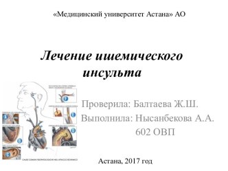 Лечение ишемического инсульта