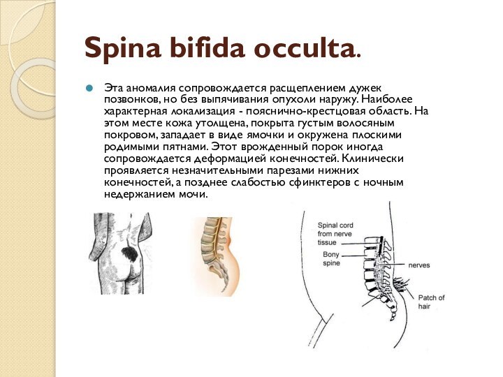 Spina bifida occulta.Эта аномалия сопровождается расщеплением дужек позвонков, но без выпячивания опухоли