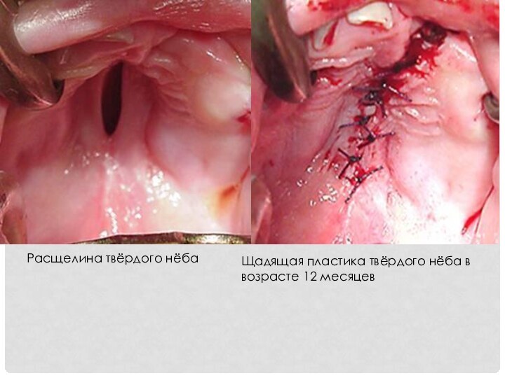 Расщелина твёрдого нёбаЩадящая пластика твёрдого нёба в возрасте 12 месяцев