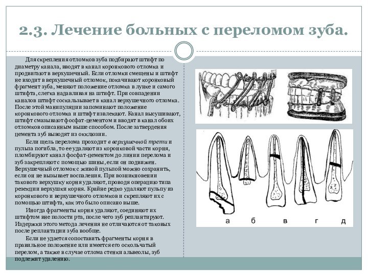 2.3. Лечение больных с переломом зуба.Для скрепления отломков зуба подбирают штифт по