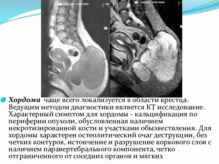 Хордома чаще всего локализуется в области крестца. Ведущим методом диагностики является КТ