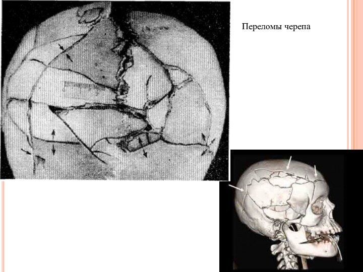 Переломы черепа