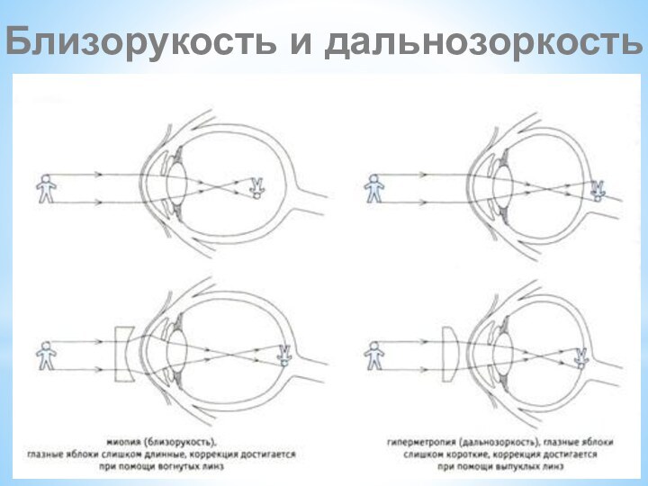 Близорукость и дальнозоркость схема