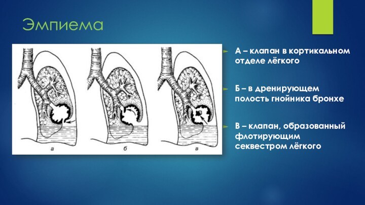 Эмпиема А – клапан в кортикальном отделе лёгкогоБ – в дренирующем полость