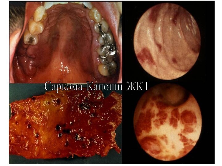 Саркома Капоши ЖКТ
