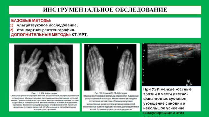 ИНСТРУМЕНТАЛЬНОЕ ОБСЛЕДОВАНИЕБАЗОВЫЕ МЕТОДЫ:ультразвуковое исследование;стандартная рентгенография.ДОПОЛНИТЕЛЬНЫЕ МЕТОДЫ: КТ, МРТ.При УЗИ мелкие костные эрозии