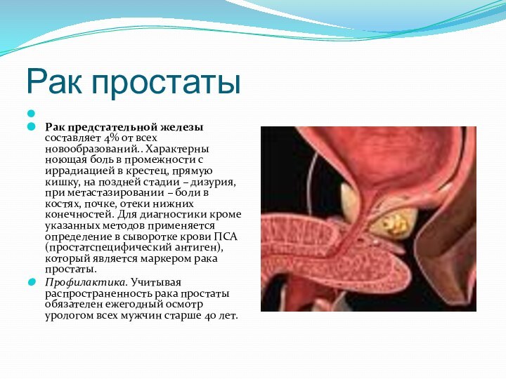 Рак простаты Рак предстательной железы составляет 4% от всех новообразований.. Характерны ноющая боль