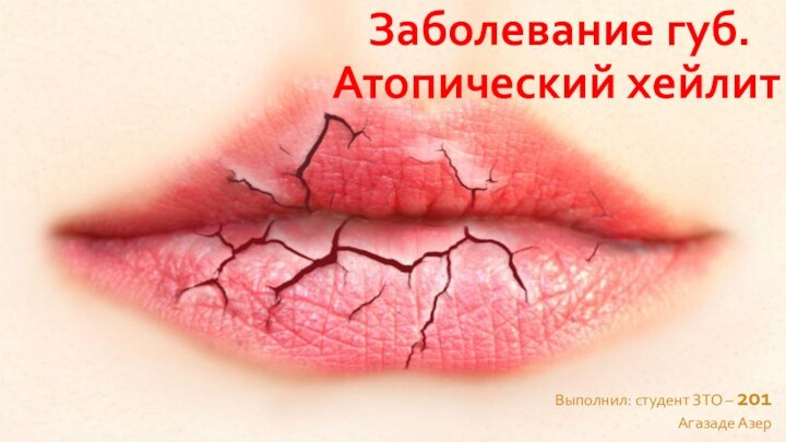 Заболевание губ. 	Атопический хейлит Выполнил: студент ЗТО – 201Агазаде Азер