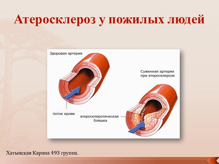 Атеросклероз у пожилых людейХатынская Карина 493 группа.