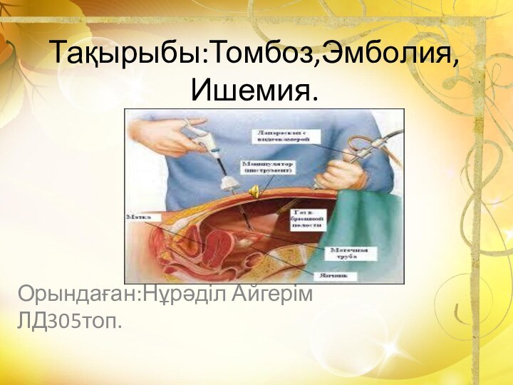 Тақырыбы:Томбоз,Эмболия, Ишемия.  Орындаған:Нұрәділ Айгерім ЛД305топ.