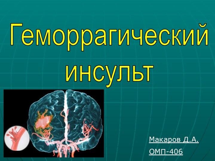 Геморрагический инсультМакаров Д.А.ОМП-406