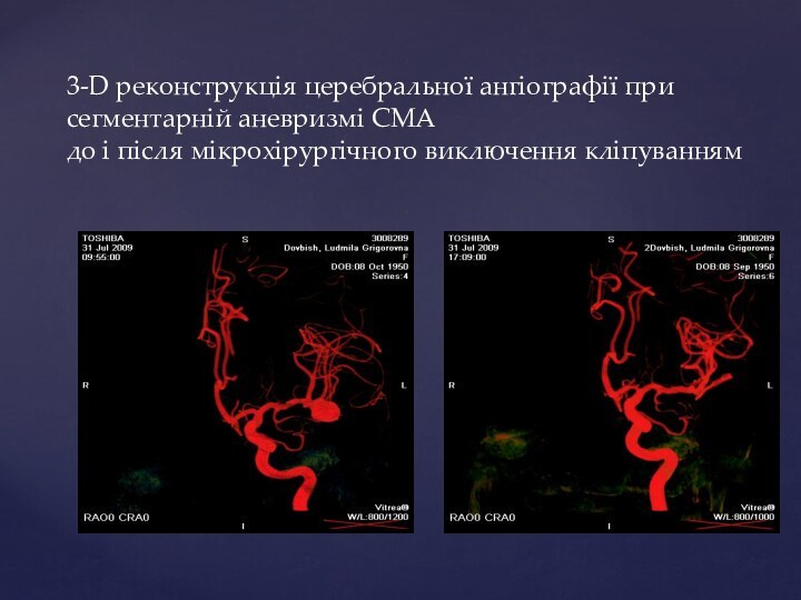 3-D реконструкція церебральної ангіографії при сегментарній аневризмі СМА до і після мікрохірургічного виключення кліпуванням