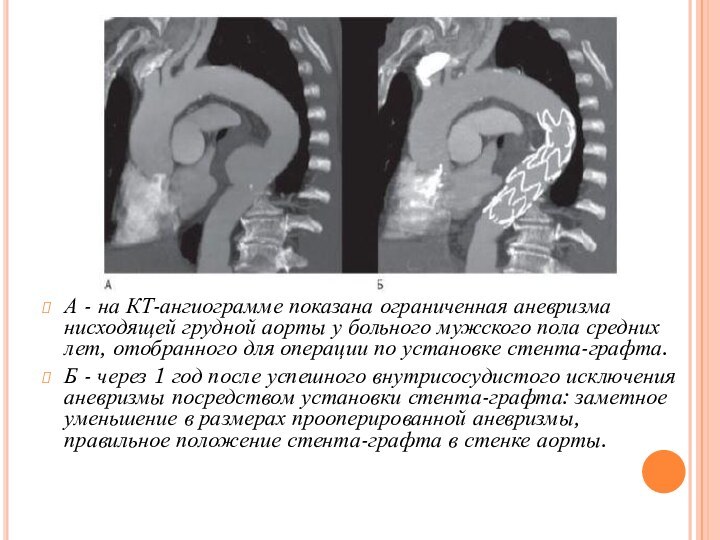А - на КТ-ангиограмме показана ограниченная аневризма нисходящей грудной аорты у больного