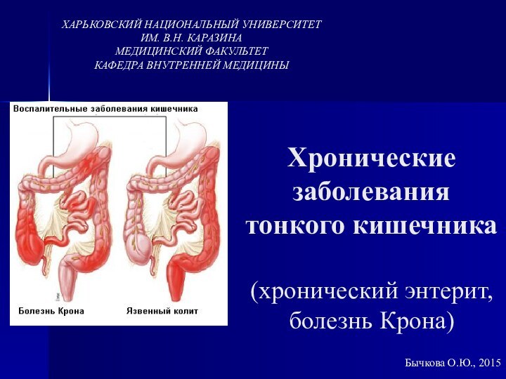 Хронические заболевания тонкого кишечника  (хронический энтерит, болезнь Крона)Бычкова О.Ю., 2015ХАРЬКОВСКИЙ