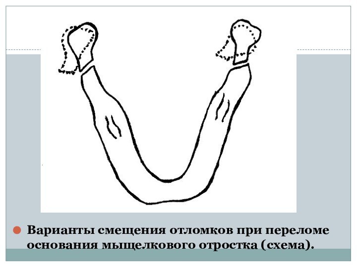 Варианты смещения отломков при переломе основания мыщелкового отростка (схема).