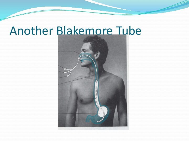 Another Blakemore Tube