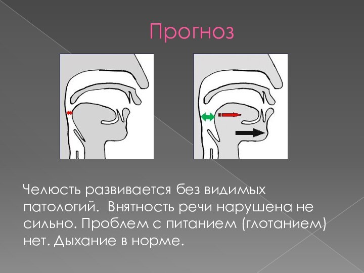 ПрогнозЧелюсть развивается без видимых патологий. Внятность речи нарушена не сильно. Проблем с