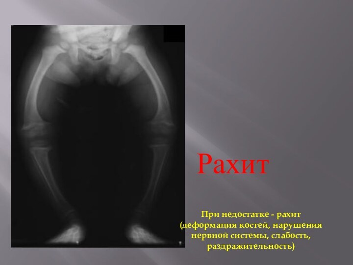 РахитПри недостатке - рахит(деформация костей, нарушениянервной системы, слабость,раздражительность)